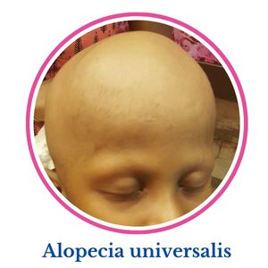 Alopecia universalis